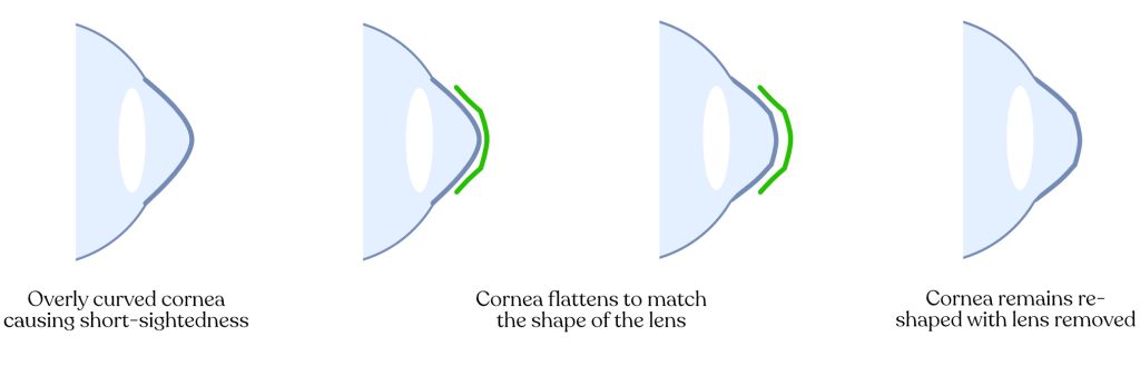 Overly curved cornea causing short-sightedness. Cornea flattens to match the shape of the lens. Cornea remains reshaped with lens removed.
