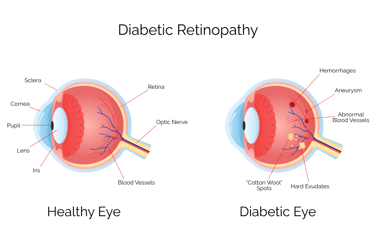 Diagram showing the differences between a healthy eye and an eye affected by diabetes.